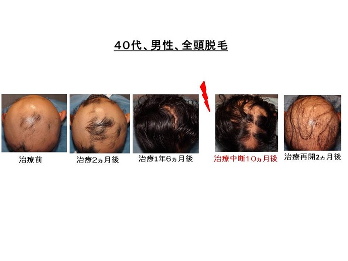 円形脱毛症　病院""